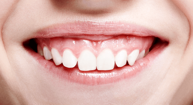笑ったとき歯ぐきが見える「ガミースマイル治療」